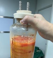 渑池水动力吸脂手术要做多久？